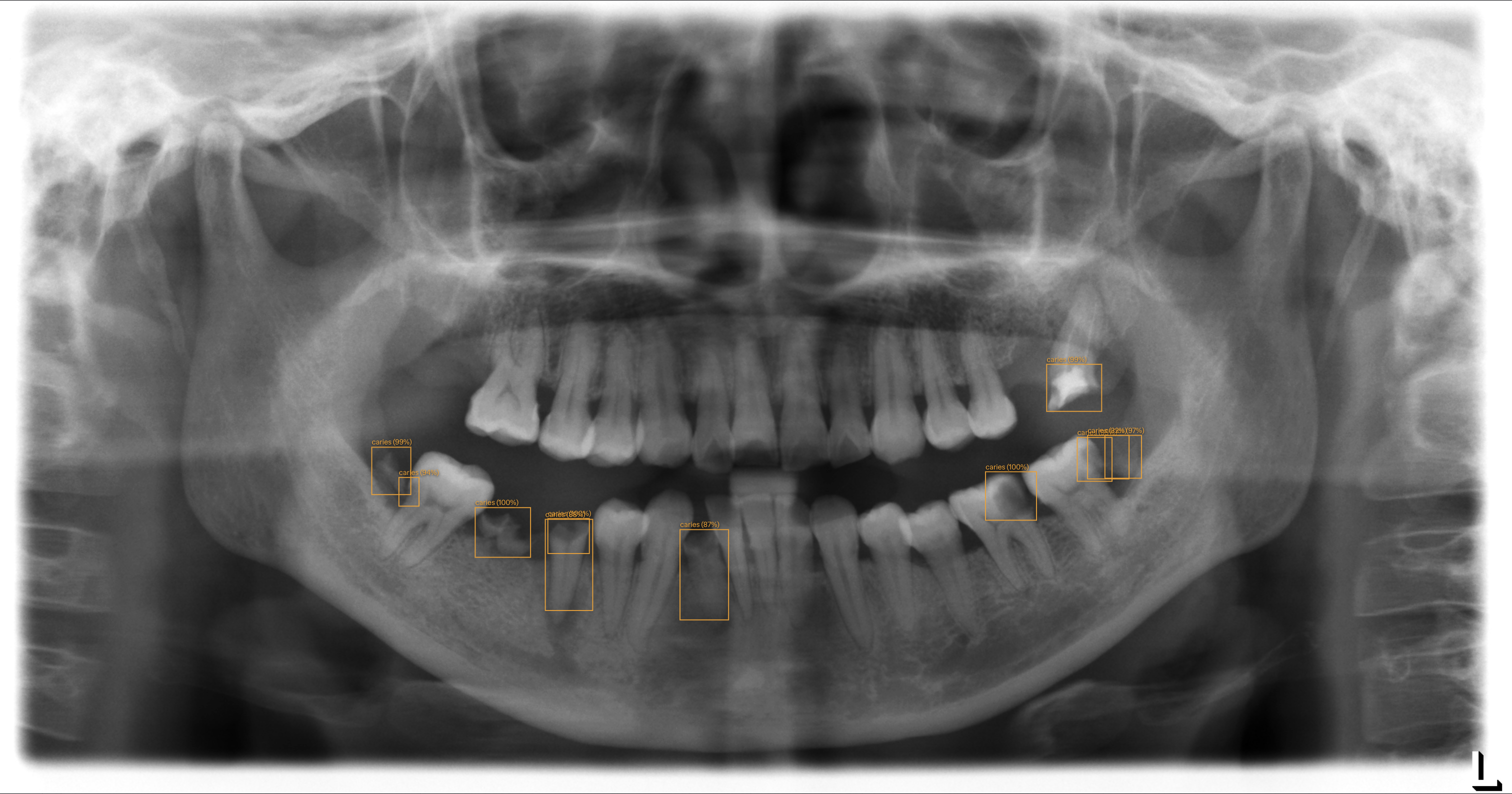 Dashboard d'imagerie — détection IA caries activée